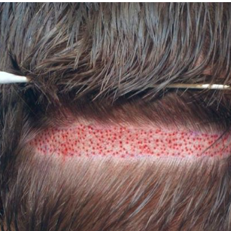 Hair Transplant In Pakistan